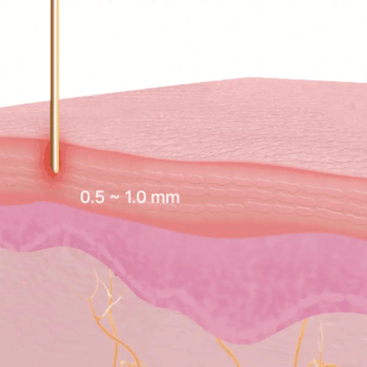 RF Microneedling Behandlung zur Hautstraffung bei Beauty Lounge Weiden